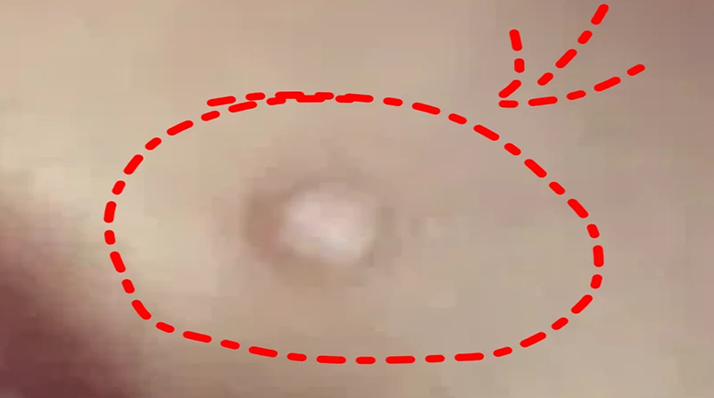 疤痕上长小白点？可能是这5种情况在作怪！