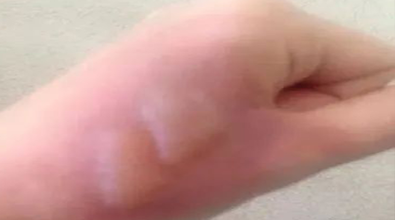 烫伤水泡戳破后护理全指南｜5大关键注意事项