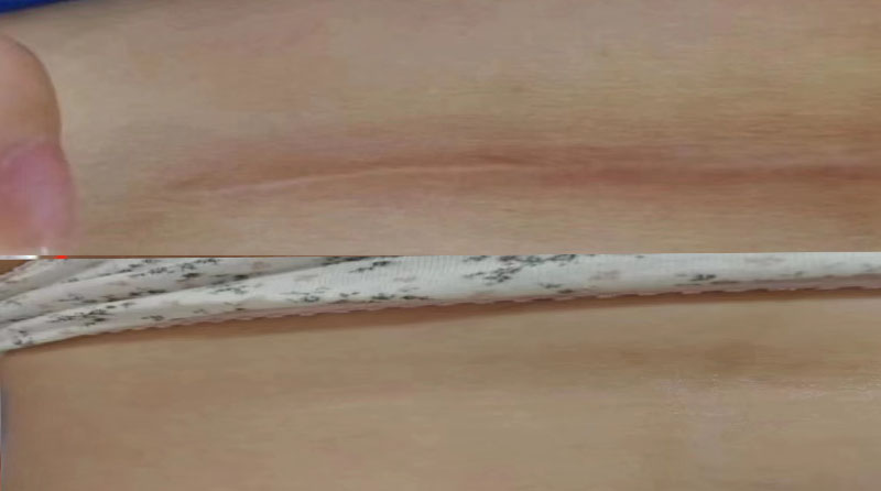 剖腹产疤痕护理指南：增生≠发炎，别让焦虑耽