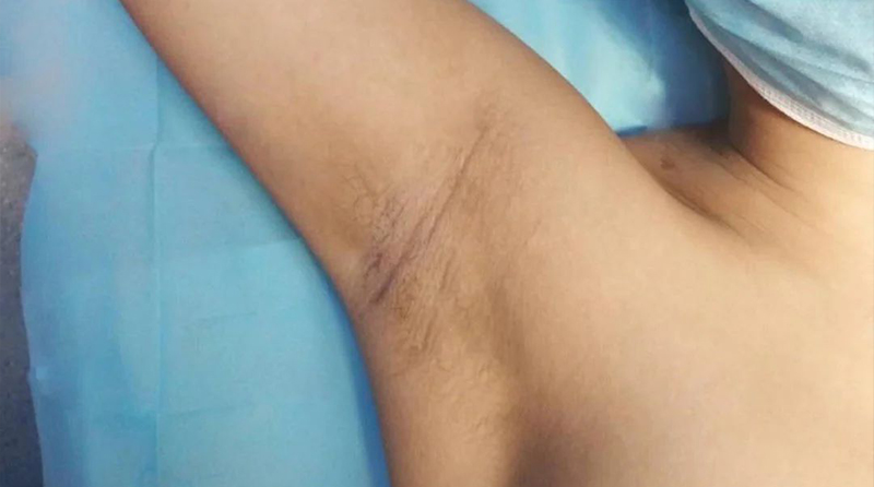如何不留疤的快速愈合腋下伤口