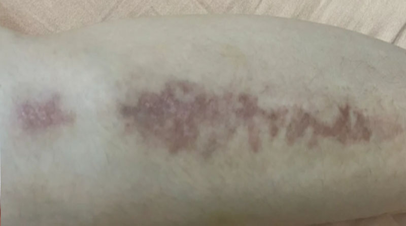 夏季防晒全攻略：科学防护，远离色素疤