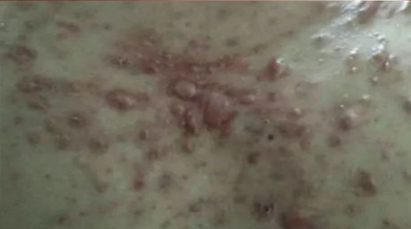 告别“小疙瘩”焦虑：非手术疗法全攻略